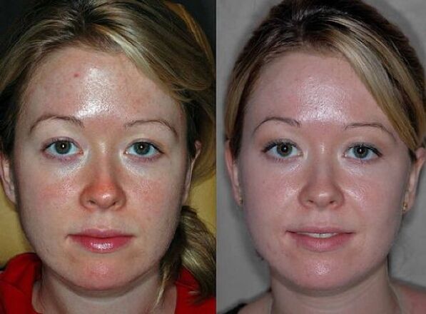 fotos antes y después del procedimiento de rejuvenecimiento con plasma