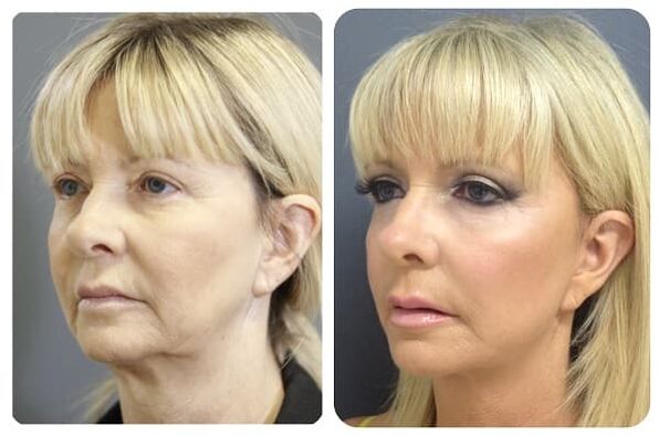 antes y después del rejuvenecimiento de la piel con foto reafirmante 2