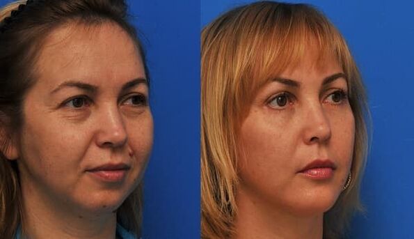antes y después del rejuvenecimiento de la piel con reafirmante foto 1