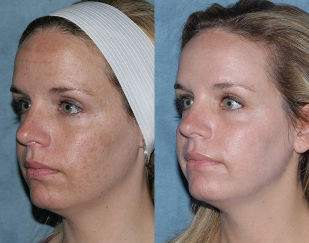 Fotos de antes y después de la fraccionaria del rejuvenecimiento de la cara