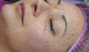 restauración de la piel después de la mesoterapia